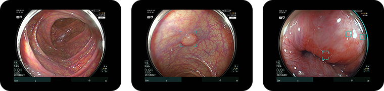 大腸カメラ検査のエコー画像