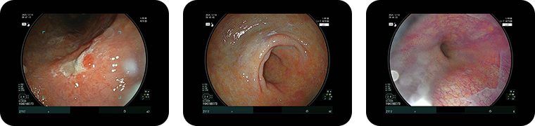 内視鏡検査のエコー画像